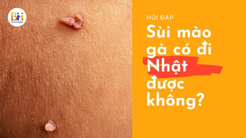 bị sùi mào gà có đi nhật được không?