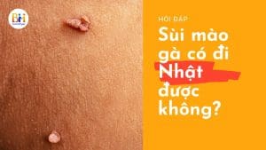 bị sùi mào gà có đi nhật được không?